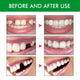 Kit de réparation temporaire des dents, fausses dents, colle solide, adhésif pour prothèse dentaire, blanchiment des dents, outil de beauté pour réparer les dents